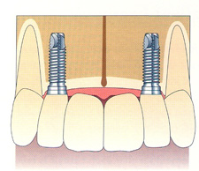 implant