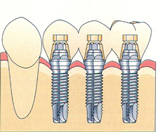 implant