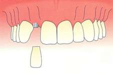 anterior single implant