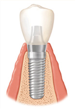 implant diagram