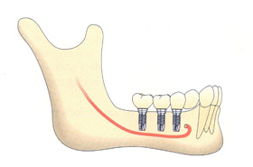 implant